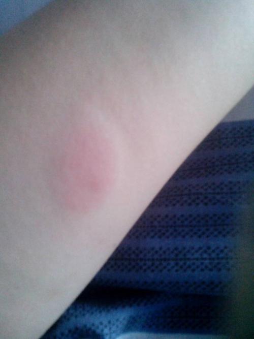 我之前得过肺结核,但是现在医生说已经稳定了,而且是阴性的,可是昨天