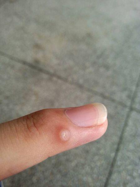 不医疗去掉瘊子 2014-05-24 陶光勇 医师 手指上长瘊子怎么才能去掉