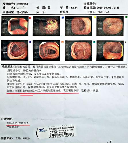"直肠下段癌"老年男性患者,61岁,术前结肠镜检查诊断:直肠癌,距肛缘约