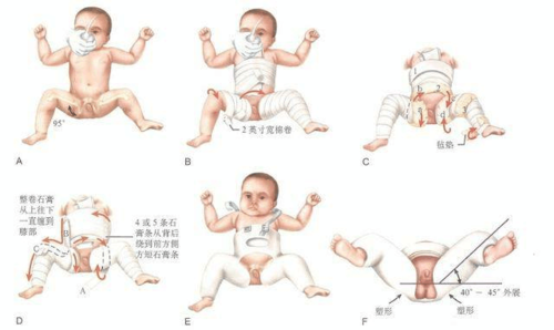 先天性髋关节脱位有三种表现,很多父母不在意,最后后悔都来不急