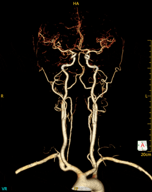乌拉特前旗人民医院影像中心带你认识头颈部血管cta成像技术