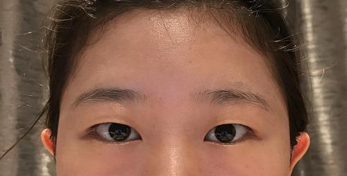 姐妹们,像我这样的纯单眼皮,肿泡眼,割了会好看吗