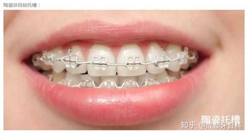 常见的陶瓷托槽有单晶(透明)和陶瓷(牙