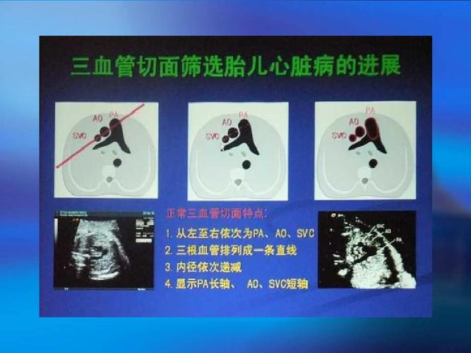 三血管切面筛选胎儿心脏病ppt