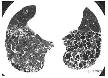 hrct影像:纤维化和蜂窝样变之特发性肺纤维化 (ipf)