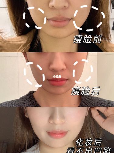 瘦脸针保妥适对比图 南京三甲医院 省人民