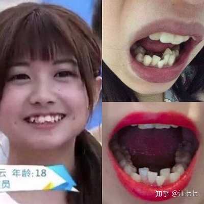 如果带牙套的话可以不拔牙吗?