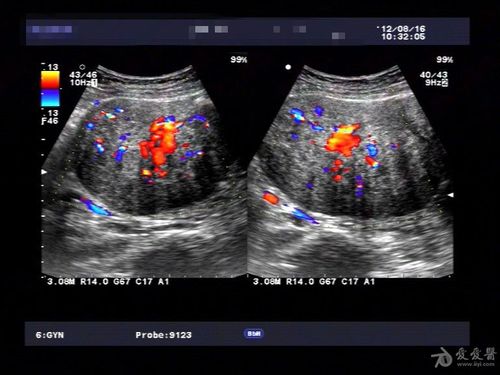 典型病例——子宫腺肌症(一) - 超声医学讨论版 - 医