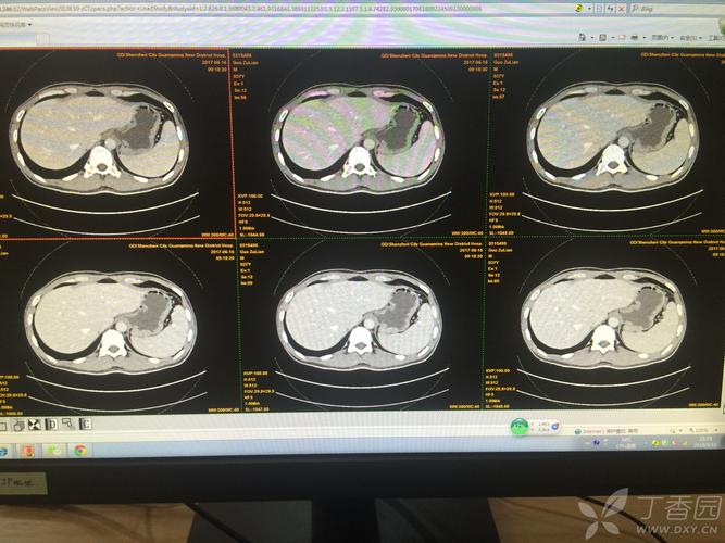 请问各位影像科大神们,如何测量脾脏是否增大,平时经常说超过5个肋