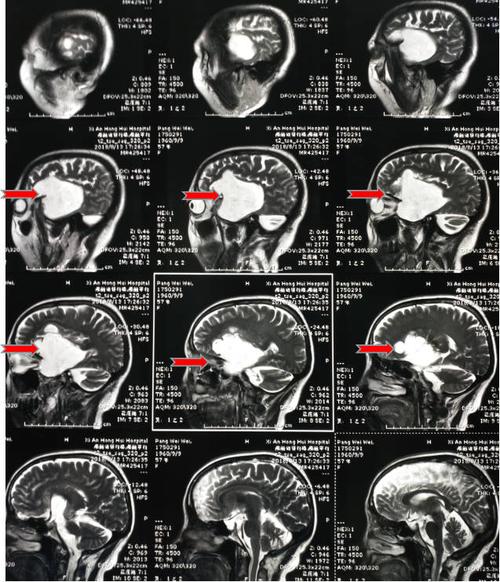 头部磁共振提示肿瘤大小约7cm