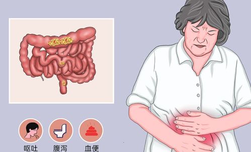 夏季需严把"饮食关"!女子吃炸鸡突发肠梗阻,医生妙手除急症