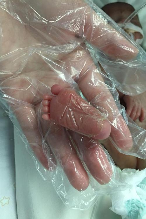 生命奇迹胎龄24周600多克的超早产儿被成功救治