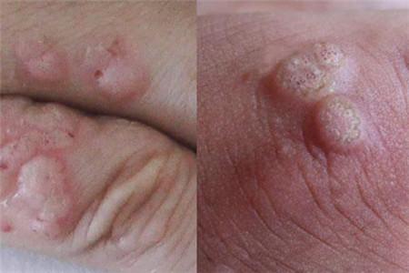 【图】鱼鳞痣的治疗方法 用这几个技巧很容易去除它
