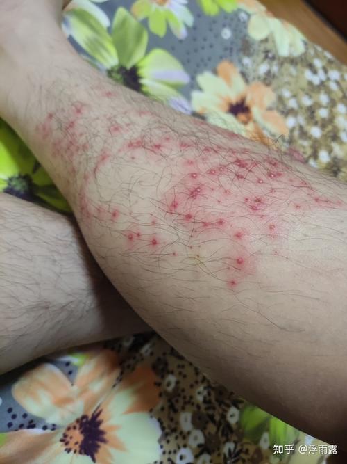 大家来看看我的腿怎么了?突然就这样了,是不是毛囊炎