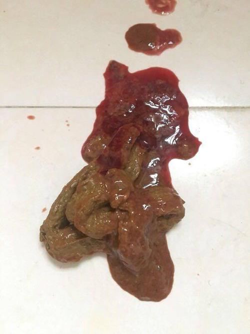 便血:溃疡性结肠炎和克罗恩病病情活动的表现(附图)