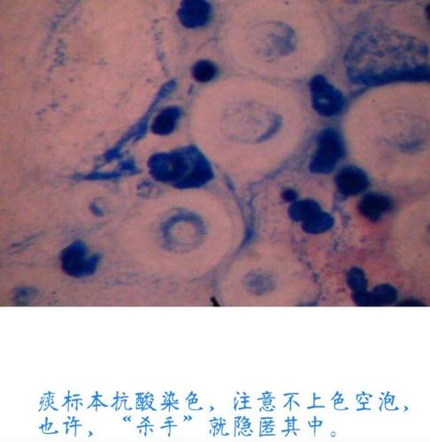 新型隐球菌