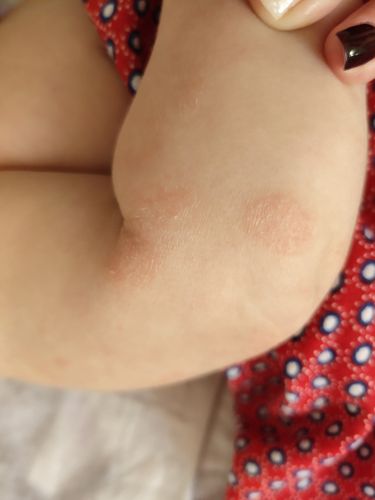 宝宝俩胳膊上长了像藓一样的东西,一晚上起来好多,请问宝妈们知道这是