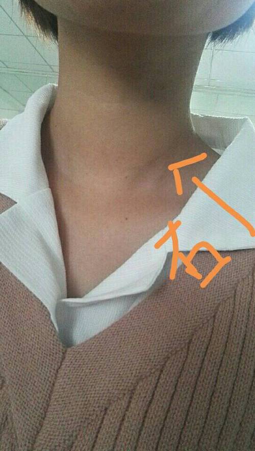 我右边的脖子肿了,会是甲状腺或咽炎吗?肿好久了,但是