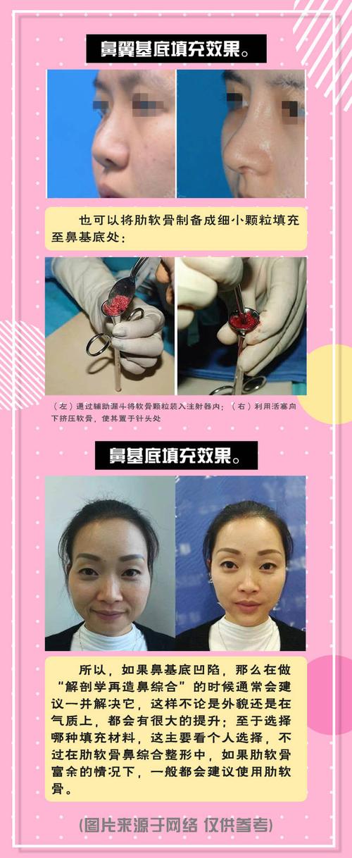 医美之都:鼻基底凹陷大揭秘!
