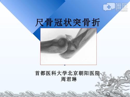 尺骨冠状突骨折