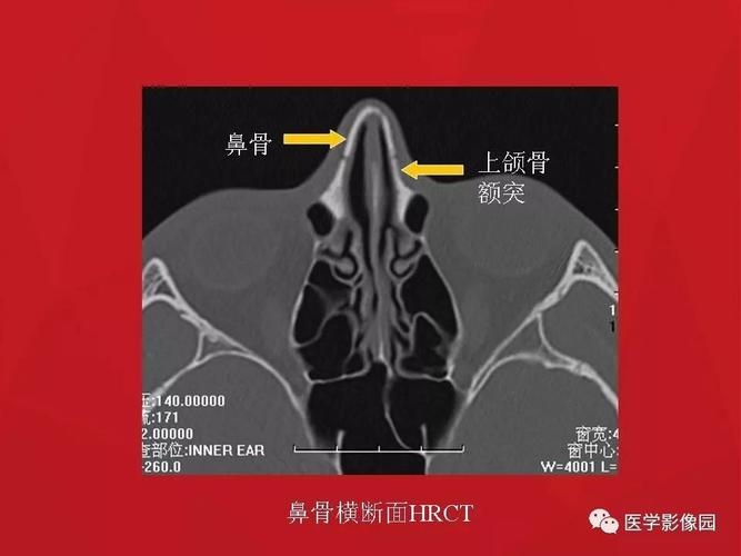 鼻骨骨折影像学诊断与鉴别