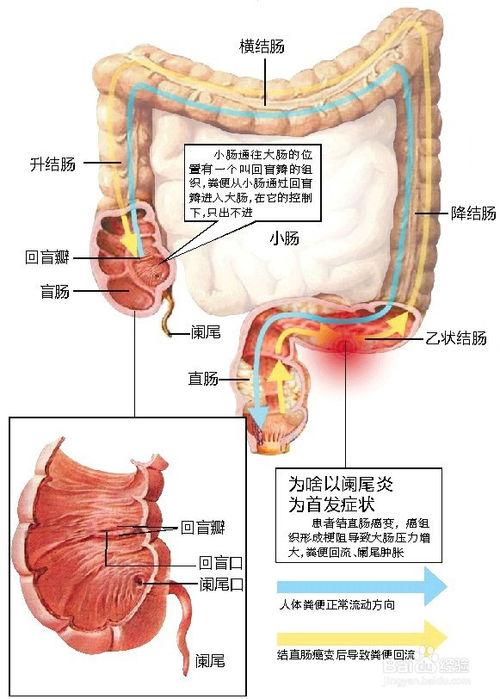 如何识别阑尾炎