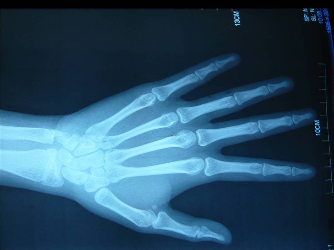 如何看我孩子的手骨照片确定她的骨龄