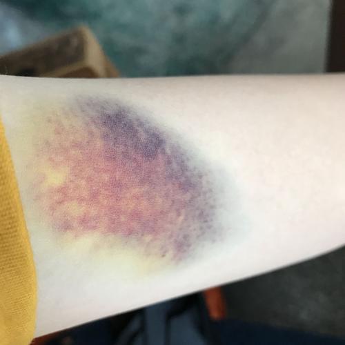 手臂撞出来的淤青成这样怎么办