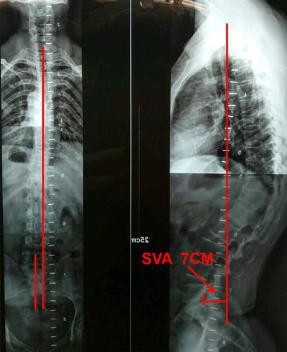 【超能刀客】"止麻先锋"故事会│005号 脊柱后凸畸形