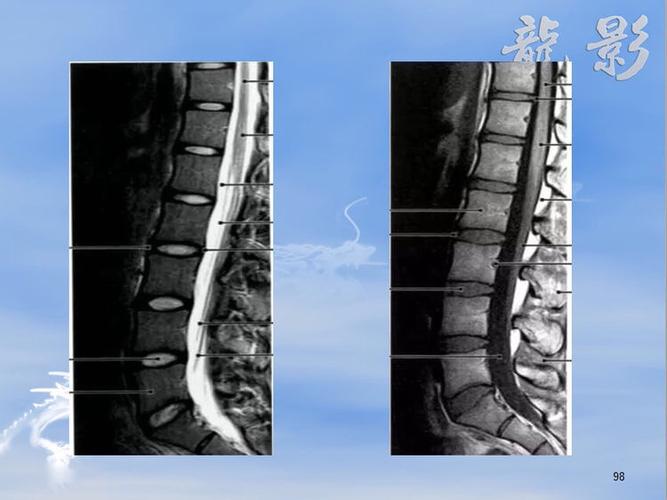 龙影 第六课 核磁共振基础知识和脊柱常用解剖