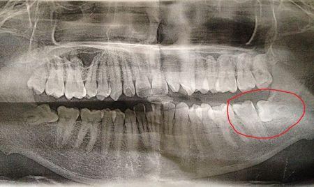 问:可能发生侧穿的龋齿是做治疗还是拔了?