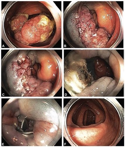 升结肠无蒂大息肉emr治疗前后对比