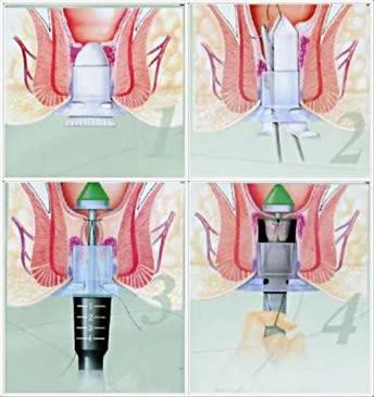 pph微创微痛技术           pph手术即吻合器痔环切术,适用于各类痔疮