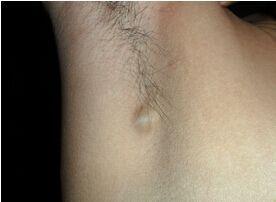 女腋下淋巴结肿大图片39健康网疾病