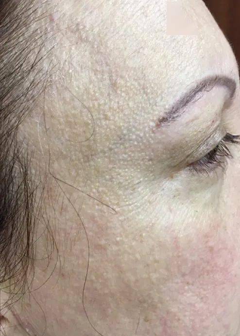 1. 颞部肤色非炎症性面部丘疹,颊部网状红斑,静脉突出