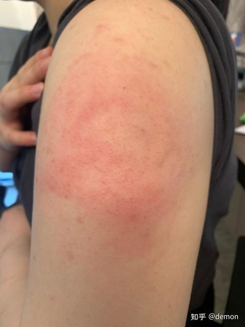 18号的胳膊不挠也是发红明显的红肿痒有点疼