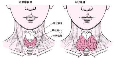 单纯性甲状腺肿|增生|囊肿|结节|弥漫性_网易订阅