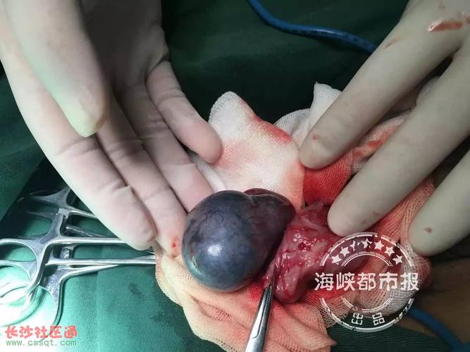 福州11岁男孩睾丸扭转360紫的像葡萄最终被切除