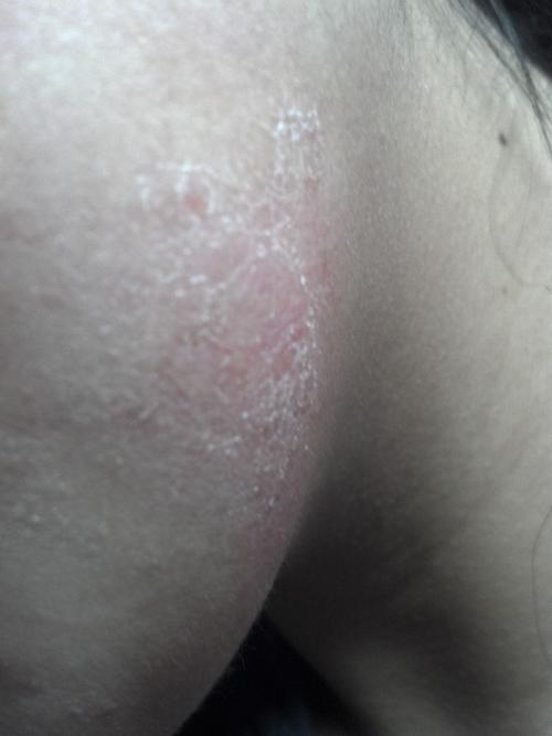 脸部夏季皮炎图片