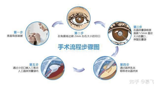 白内障手术流程是?