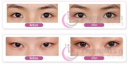 开眼角手术前后对比图