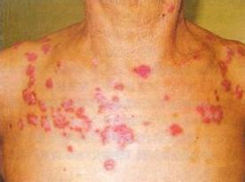 盘状红斑肉芽肿