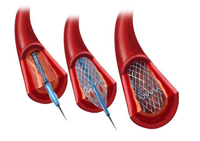 网易首页>网易号>正文申请入驻> 经皮冠状动脉支架介入治疗(pci),就是