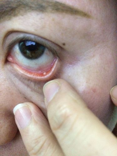 下眼睑长了颗白色颗粒