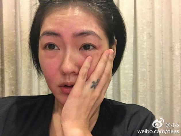 小s和老公过情人节 喝酒过敏满脸红疹(组图)(3)