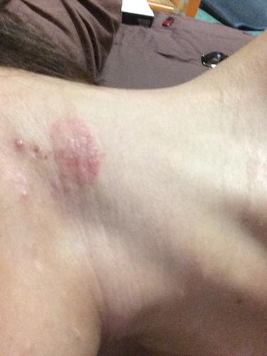 问:这是怎么回事.很痒.脱皮.皮肤鼓起