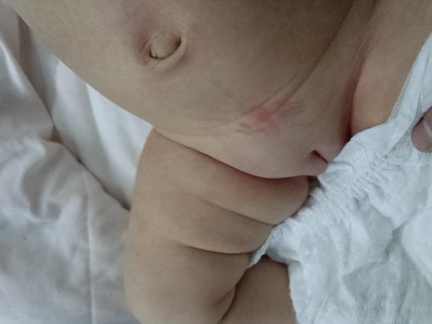 小儿腹股沟疝(疝气)何时手术为好?