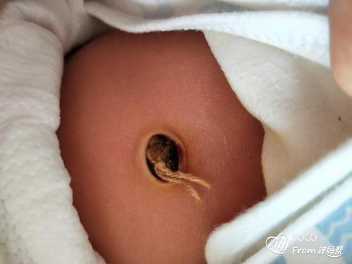 黄色的是不是有脓包呀 新生儿十天了 脐带还没脱落[羡慕]