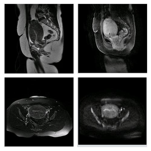 核磁共振平扫加增强,子宫腺肌症