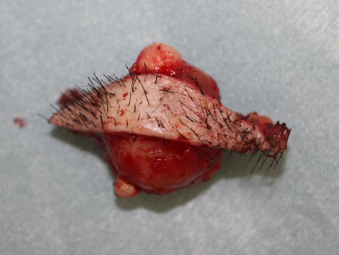 粉瘤- ssクリニック - 皮肤科99美容外科 - 名古屋市中区